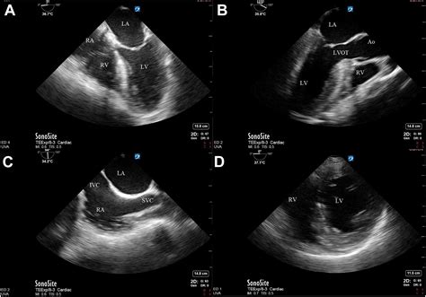 Focused Ultrasonography In Cardiac Arrest Emergency Medicine Clinics