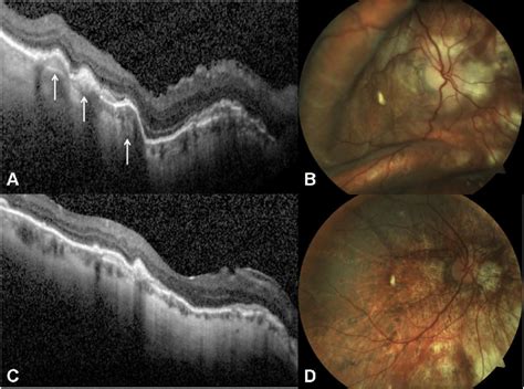 A Macular Time Domain Optical Coherence Tomography Linear Scan