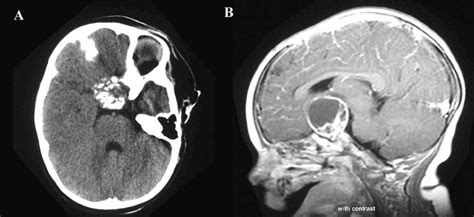 A Brain Ct Showing A Suprasellar Mass With Calcifications B