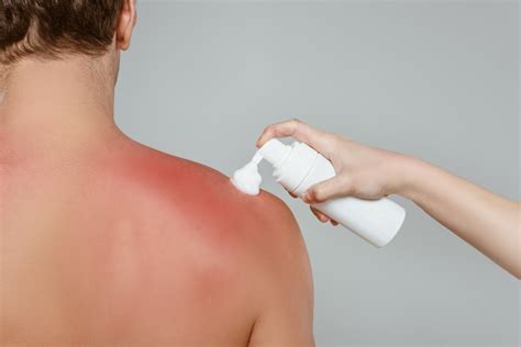 Sun Poisoning Vs Sunburn The Important Differences