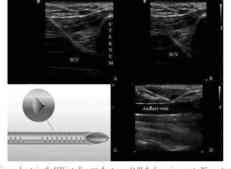 Figure 2 From Optimization Of Cannula Visibility During Ultrasound