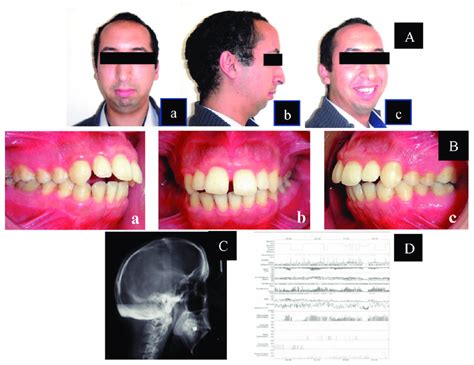 A Pretreatment Extraoral Photographs A Frontal At Rest B