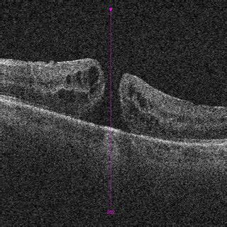 OCT image of the macula 10 weeks after surgery showing a full-thickness... | Download Scientific ...