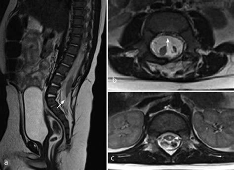 Postoperative Magnetic Resonance Imaging One Year After Surgery A