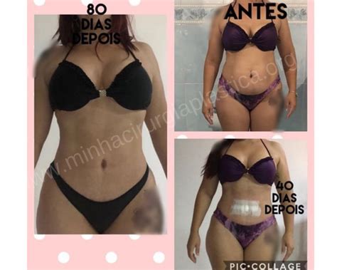 Abdominoplastia vibrolipo no cóccix Mastopexia prótese de