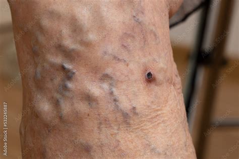 Cropped Bare Leg With Ulcer Varicose Veins Edema Skin Dermatology And