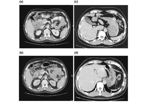 A Axial Computed Tomography Ct Of A Duodenal Gastrointestinal Stromal