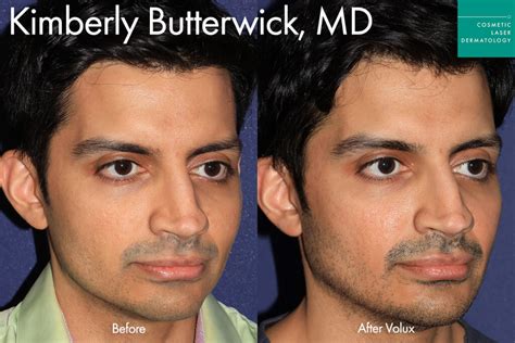 Juvéderm Volux Cosmetic Laser Dermatology Skin Specialists In San Diego