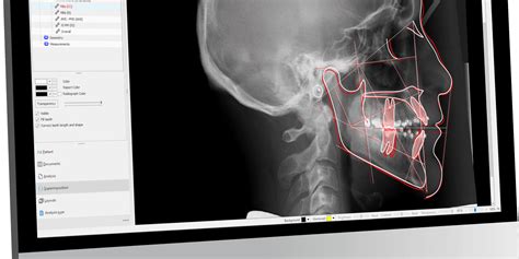 Owandy To Showcase Ai Ceph Analysis Tool Orthodontic Products