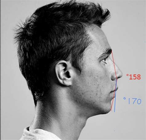 How Do You Measure Chin Projection R Orthotropics