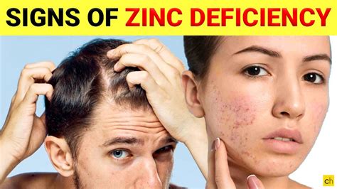 Do You Know These Shocking Signs Of Zinc Deficiency Credihealth