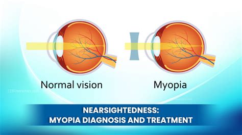 Nearsightedness: Myopia Diagnosis And Treatment - DLEI