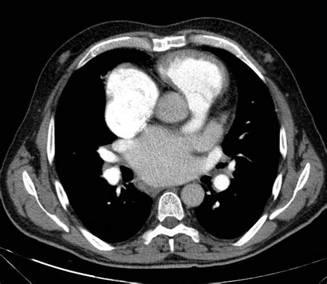 MacCallum S Patch Rheumatic Heart Disease Image Radiopaedia Org