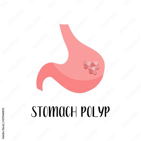 Stomach Polyp Gastric Disease Gastroenterology Vector Flat Illustration Perfect For Flyer