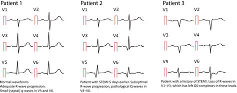 Ecg Interpretation Characteristics Of The Normal Ecg P Wave Qrs Complex St Segment T Wave