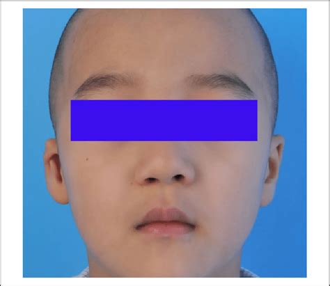 Preoperative Frontal View Of The Patient 2 Download Scientific Diagram