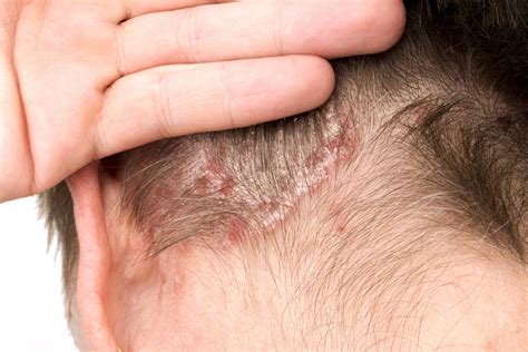 Scalp Psoriasis Treatment Discover Effective Scalp Psoriasis