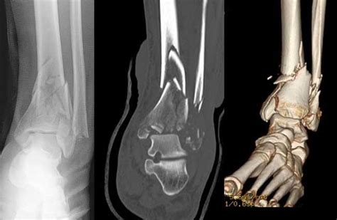 Pilon Fractures Of The Ankle Orthoinfo Aaos