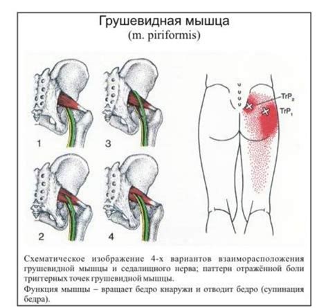 Синдром грушевидной мышцы — симптомы и лечение, упражнения