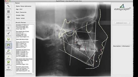 Tutorial 2 Online Lateral Cephalometric Tracing With Easyceph® Demo Youtube