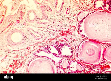 Hyperplasie De La Prostate Photomicrographe Montrant Les Glandes