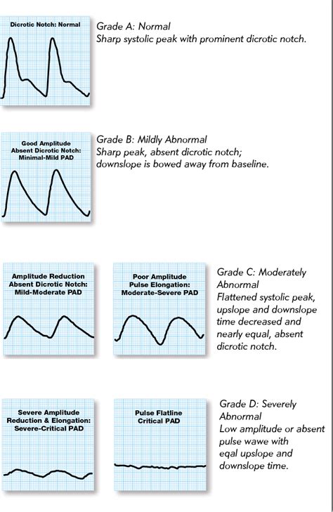 Pdf The Utility Of Pulse Volume Waveforms In The Identification Of