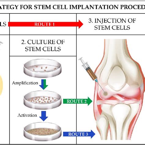 Schematic Diagram Of Autologous Chondrocyte Implantation Aci