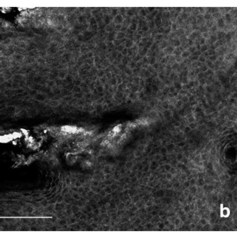 Confocal Laser Microscopy Of Aks Epidermal Layer A Grade 1 Ak Download Scientific Diagram