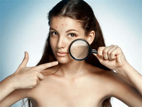 Ayurvedic Treatment For Acne Pimples