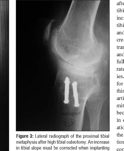 Figure 3 From Total Knee Arthroplasty After High Tibial Osteotomy