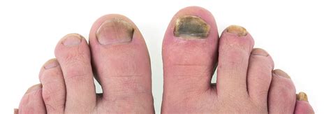 Preliminary Signs of a Foot Infection and What to Do About It – Blizzard