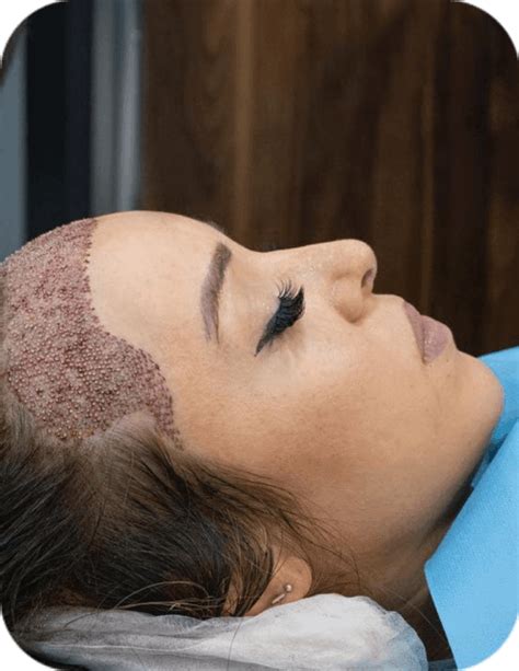 FUE Women Hair Transplant The Solution For Female Hair Loss Hair Of