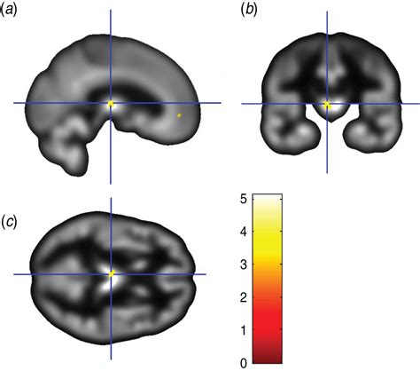 Reduced Gray Matter Volume In The Anterior Cingulate Orbitofrontal