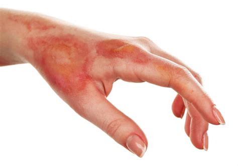 A non-invasive method developed to assess burn wound healing