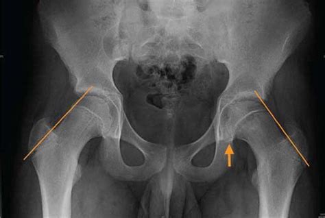 Slipped Capital Femoral Epiphysis