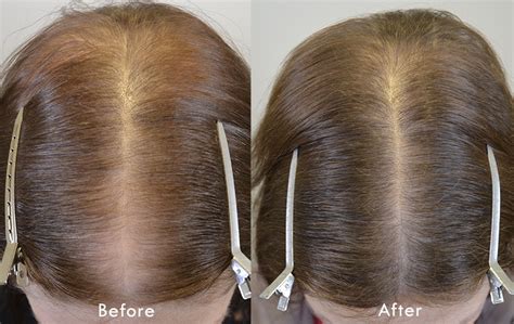 5mg Finasteride For Female Hair Loss - Hair Restoration of the South