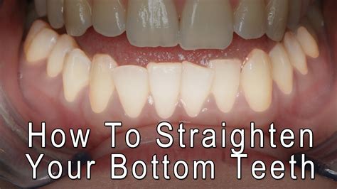 How To Get Straight Teeth Without Braces Teeth Bottom Braces Straighten