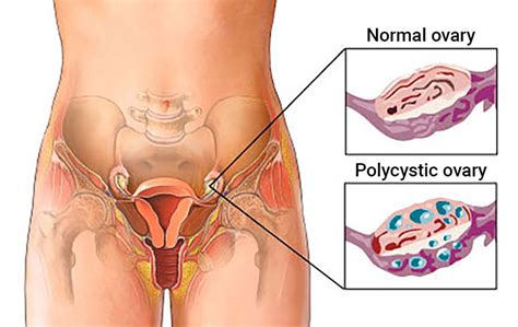 Polycystic Ovary Syndrome Functional Medical Corporation