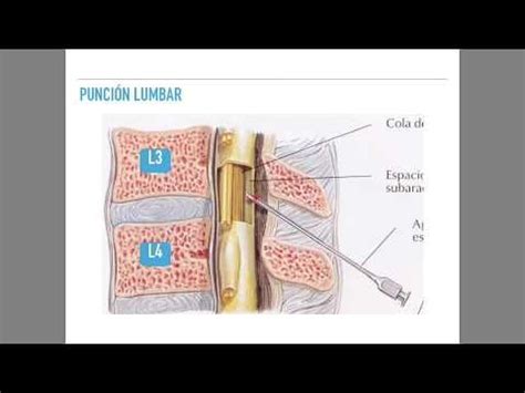 Punción lumbar y análisis de LCR YouTube Punción lumbar Puncion