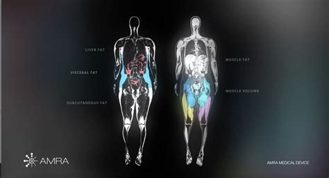 AMRA Medicals MRI Based Muscle Assessment Technology Approved For