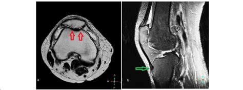 a, b MRI images for grade IV chondromalacia patella with infrapatellar ...