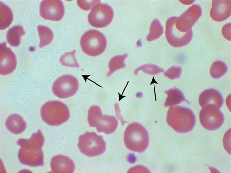 Thrombotic Thrombocytopenic Purpura Diseases Conditions