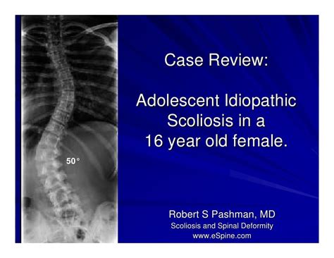 Case Review D 16 Year Old Female With Adolescent Idiopathic Scolios