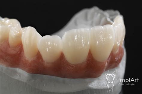 Prótese Dentária Fixa em Zircônia Translúcida Excelência