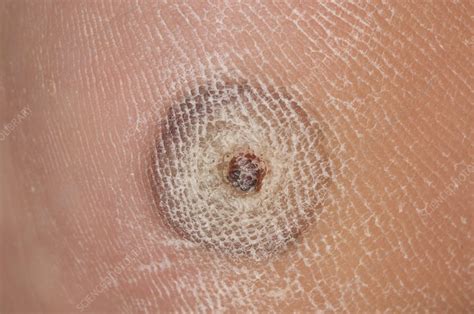 Wart After Freezing Treatment Stock Image C008 5751 Science Photo