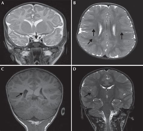 Jle Epileptic Disorders Early Life Epileptic Encephalopathy