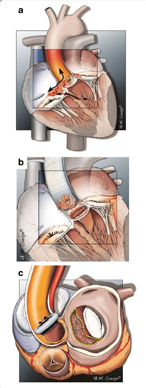 Aortic Valve Endocarditis With Paravalvular Abscess Formation