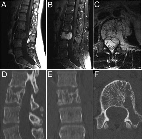 Lumbar Vertebral Hemangioma Presenting With The Acute Onset Of