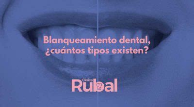 Tipos De Blanqueamiento Dental Descubre Todos Los Que Existen