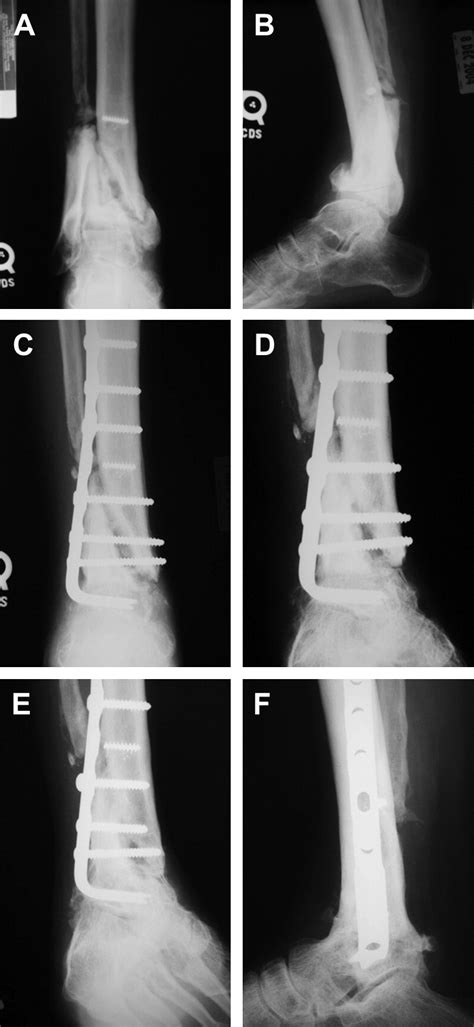 Biologics In Foot And Ankle Surgery Foot And Ankle Clinics